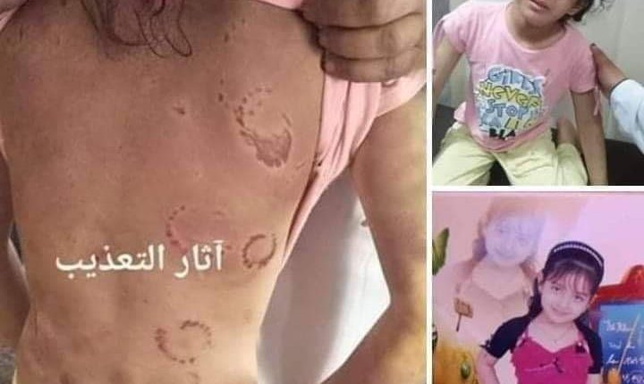 ضرب مبرح على جسد هذه الطفلة وكسر أربعة أضلع.. ونزيف.. تفاصيل