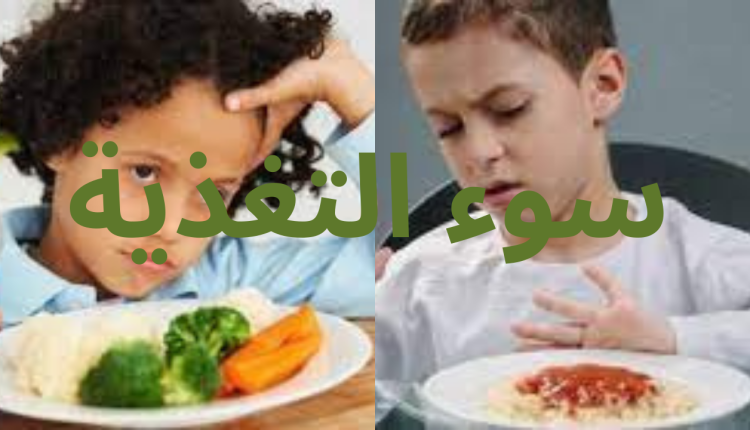 تقرير أممي: 2 مليون أردني يعانون من سوء التغذية