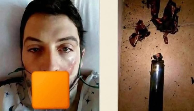 انفجار ڤيب في فم شاب عشريني يُحوّله إلى مأساة صحية خلال ثوانٍ