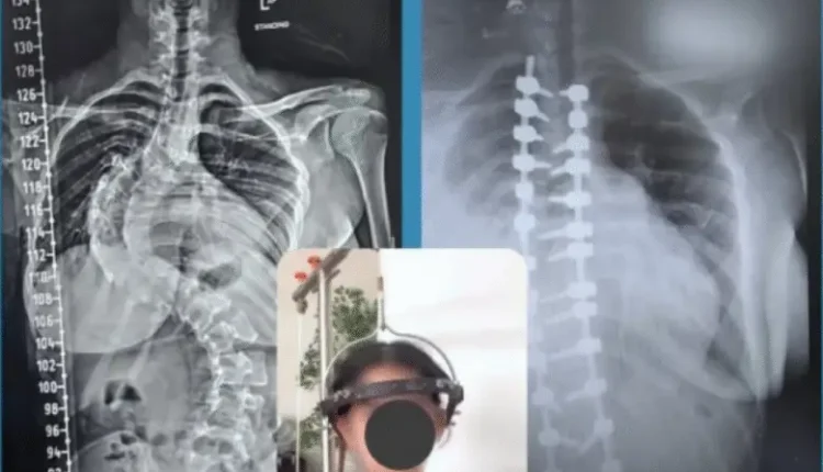 إنجاز طبي جديد في جراحة العمود الفقري بمستشفى حمزة