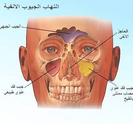 متى يتم اللجوء للجراحة لعلاج ‫التهاب الجيوب الأنفية؟