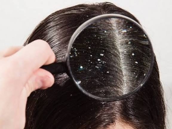 لإزالة قشرة الشعر اليك طريقة طبيعية وطرق تحضيرها بعلاجات منزلية