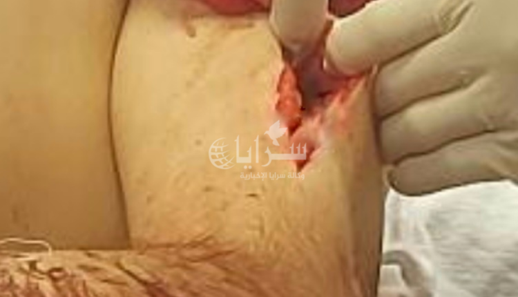 الاردن…طعن وبتر إصبع داخل منزل في جبل النصر.. شاب عشريني ضحية اعتداء على خلفية رفض زواج