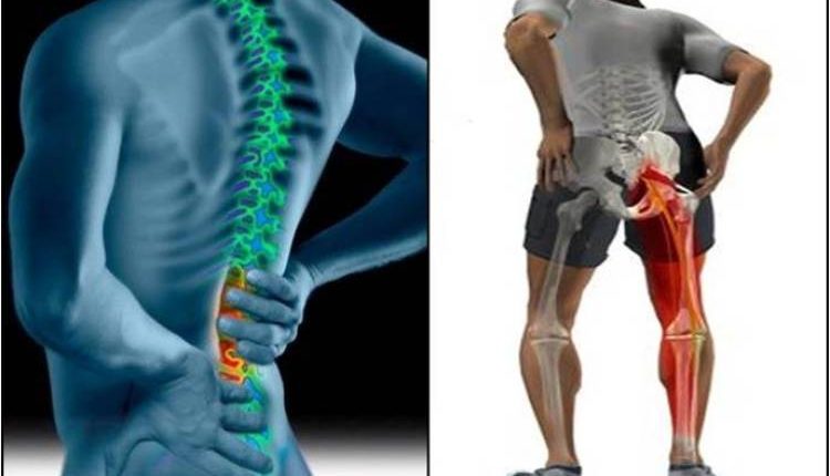 عرق النسا .. من الأعراض الأولية إلى قرار الجراحة